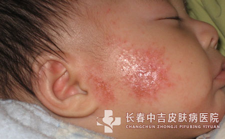 湿疹,湿疹症状,长春中吉皮肤病医院