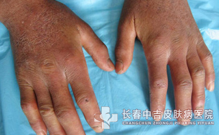 儿童皮肌炎应如何预防呢