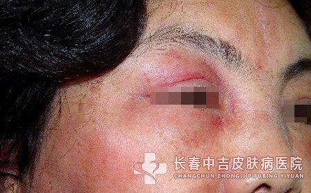 皮炎,皮炎症状,长春中吉皮肤病医院