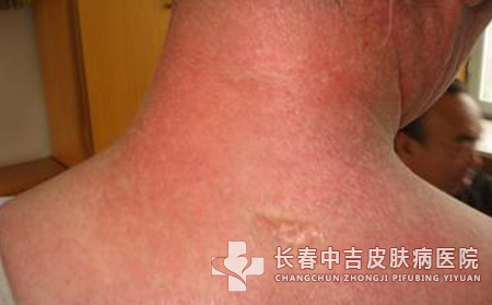 皮肌炎病因,皮肌炎患者,长春中吉皮肤病医院