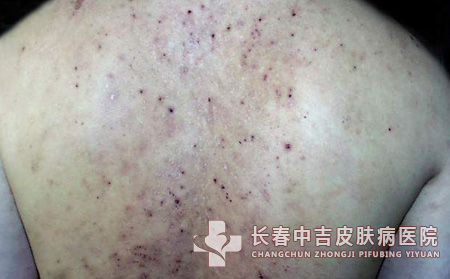 皮炎,皮炎症状,长春中吉皮肤病医院