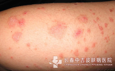 皮炎,皮炎症状,长春中吉皮肤病医院