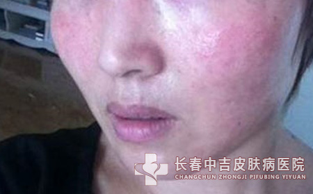 皮肤过敏不要自已擅自买药膏抹