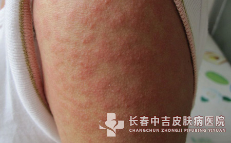 皮炎,皮炎症状