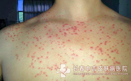 皮炎,皮炎症状