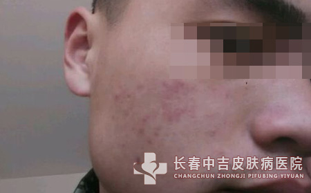 抗过敏药物更易过敏
