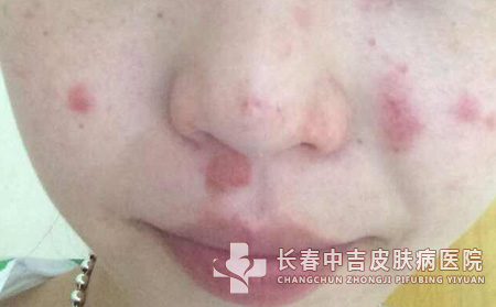 这样吃抗过敏药更有效