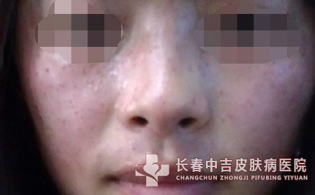 雀斑有哪些形成原因