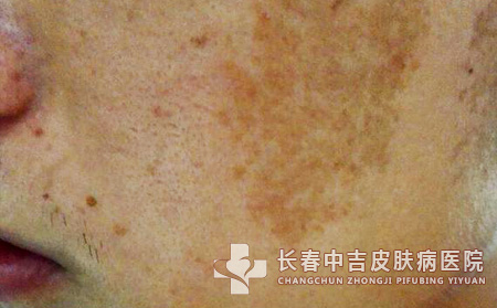雀斑是否会遗传呢