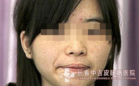 雀斑的形成有哪些内在因素