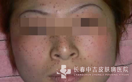 雀斑发病的病因有哪些
