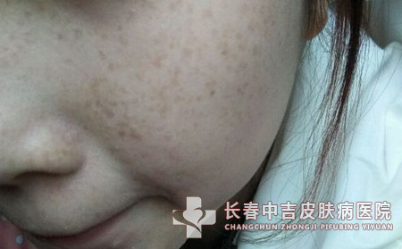 导致雀斑发病的病因是什么