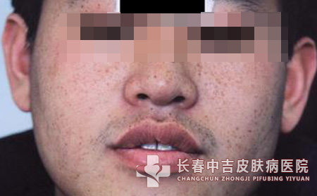 男性会长雀斑吗