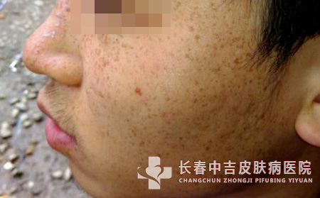 雀斑与哪些因素相关