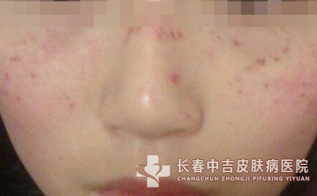 形成雀斑的主要原因
