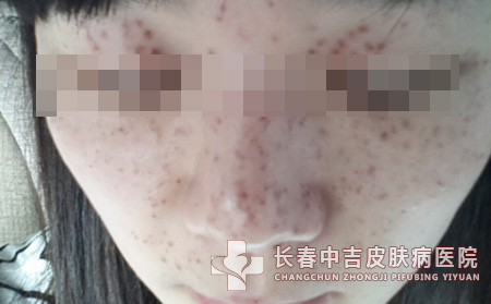 常见的引起雀斑的因素