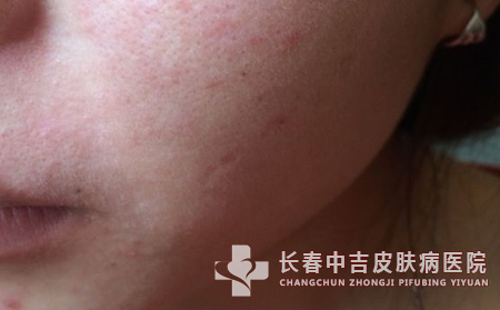 尘螨过敏怎么预防？