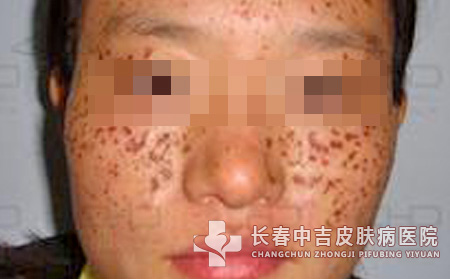 鼻子两侧雀斑是怎么引起的