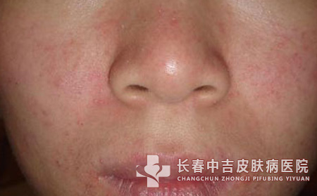 敏感性皮肤的应对措施