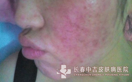 脸部皮肤过敏怎么办之自救法
