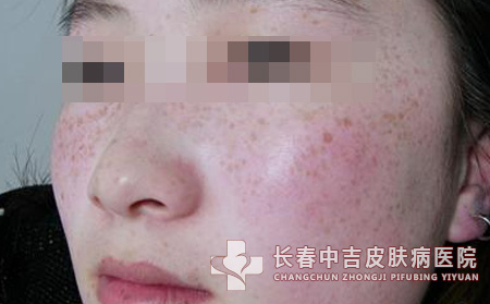 脸上长雀斑如何去除
