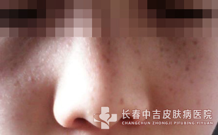 祛斑需要注意哪些禁忌事项