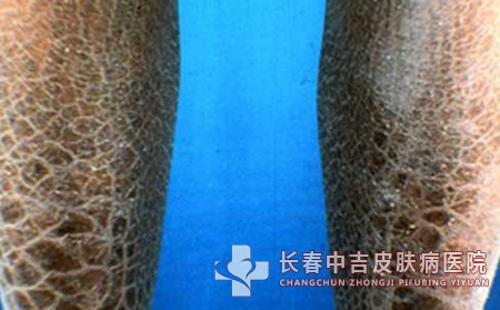 鱼鳞病是什么症状