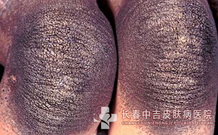 鱼鳞病什么症状