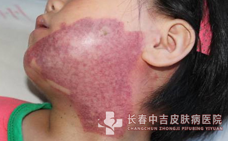 鲜红斑痣,鲜红斑痣预防,长春中吉皮肤病医院