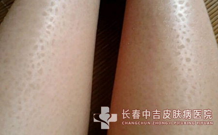 鱼鳞病得图片