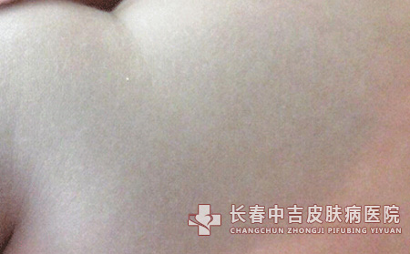太田痣的诱发因素有哪些呢