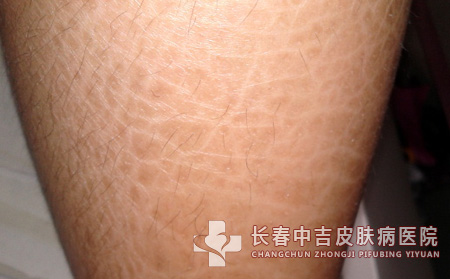 鱼鳞病吧
