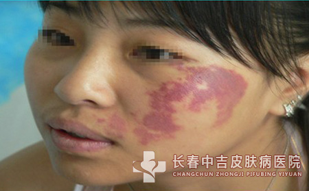 鲜红斑痣,鲜红斑痣预防,长春中吉皮肤病医院