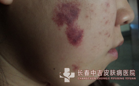患上鲜红斑痣的症状是什么