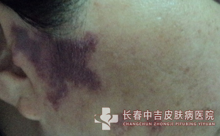 鲜红斑,鲜红斑痣预防,长春中吉皮肤病医院