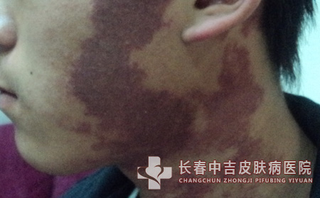如何诊断鲜红斑痣的症状表现呢