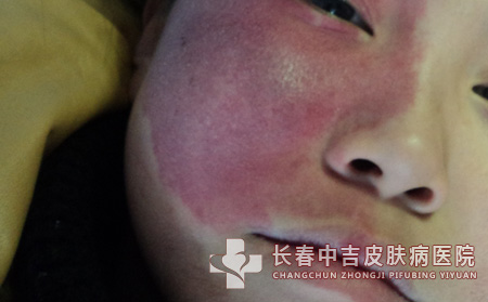 鲜红斑,鲜红斑痣预防,长春中吉皮肤病医院