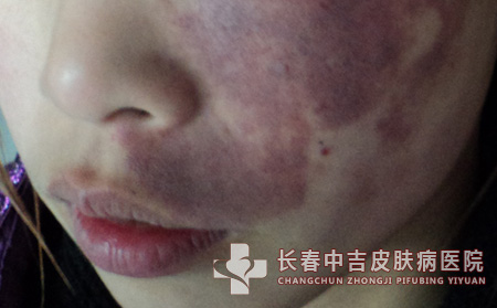 鲜红斑,鲜红斑痣预防,长春中吉皮肤病医院