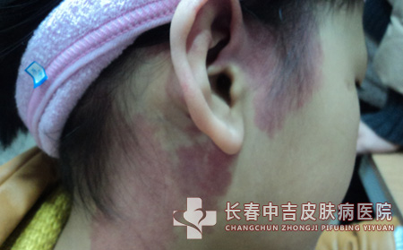 宝宝鲜红斑痣图片