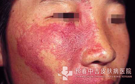 鲜红斑痣,鲜红斑痣预防,长春中吉皮肤病医院