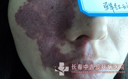 鲜红斑痣,鲜红斑痣预防,长春中吉皮肤病医院