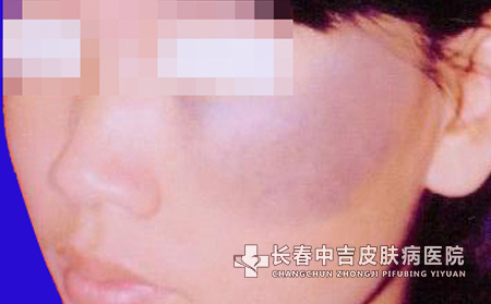 哪些原因引起的太田痣