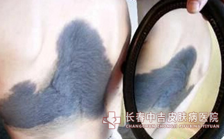 导致太田痣发病的病因有哪些