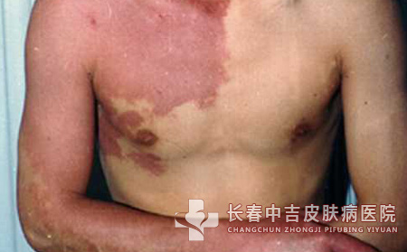 鲜红斑痣,鲜红斑痣预防,长春中吉皮肤病医院