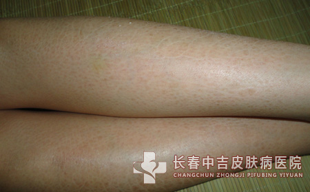 鱼鳞病有哪些方面症状