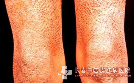鱼鳞病给患者造成哪些方面的危害
