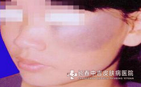 太田痣怎么形成