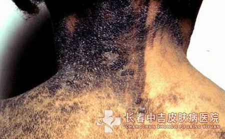 鱼鳞病的发病特征