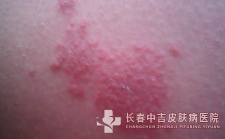荨麻疹患者的饮食禁忌