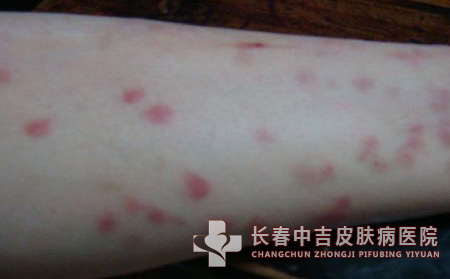荨麻疹的西医治疗